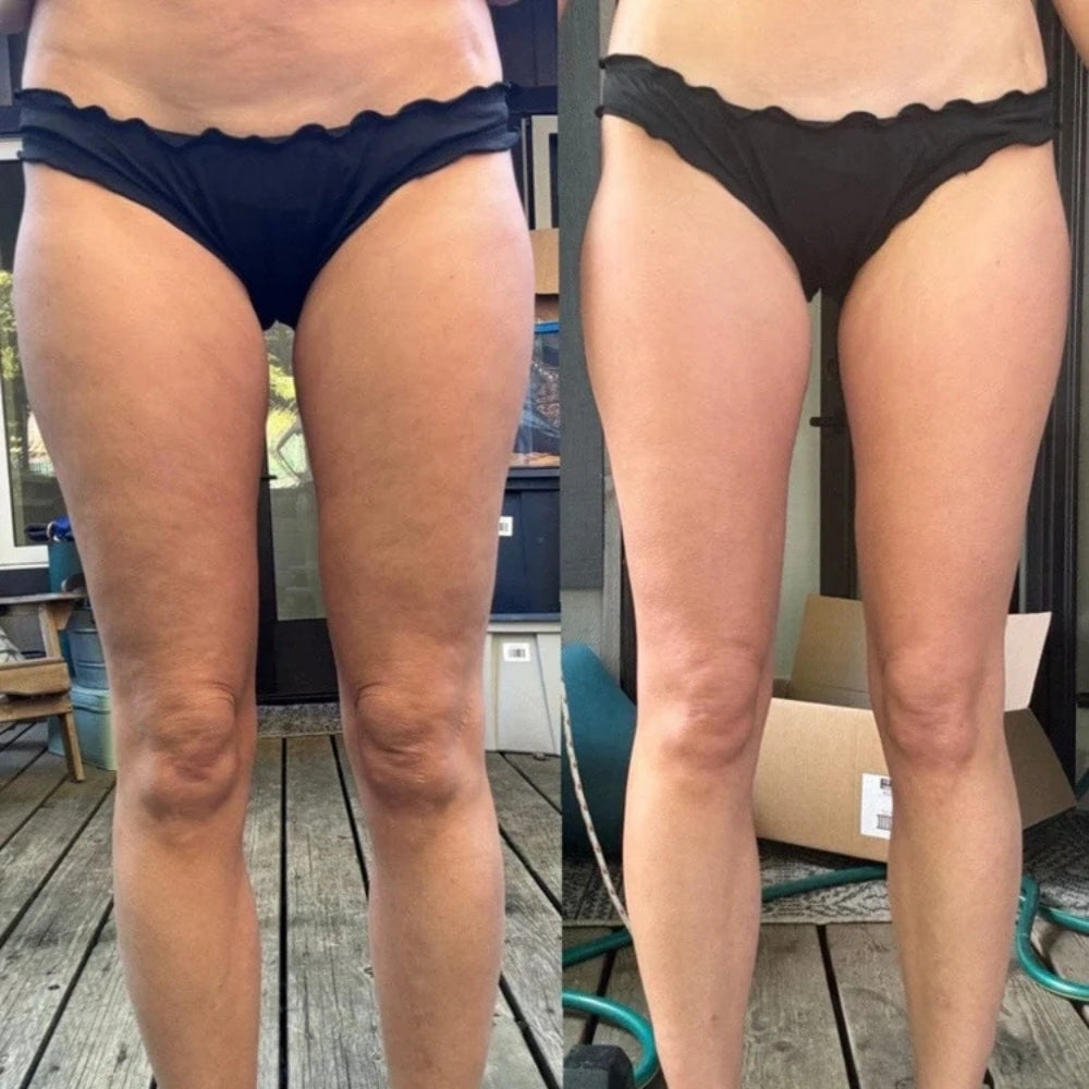 CelluGlow™ - Anti-Cellulite Massager