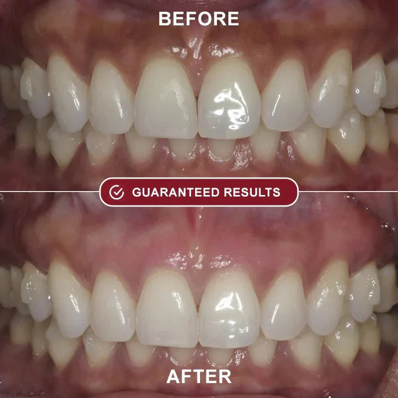 Brillia™ - Teeth Whitening Kit