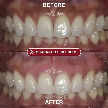 Brillia™ - Teeth Whitening Kit
